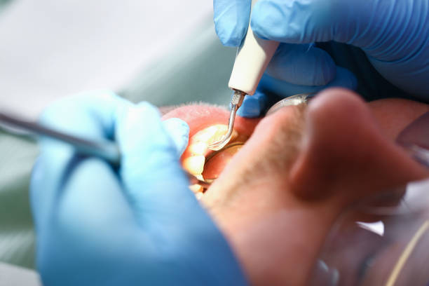 Best Emergency Tooth Extraction in Meridian, CO