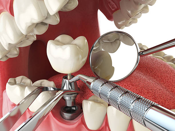 Best Emergency Broken Tooth Repair in Meridian, CO